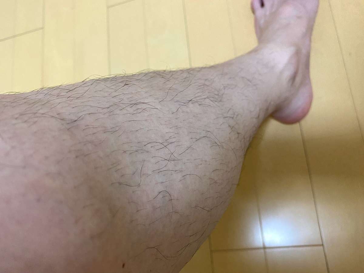 全身脱毛2回目の効果4カ月後