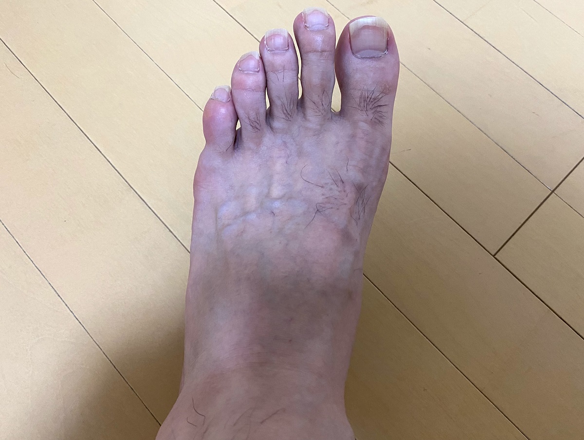 全身脱毛2回目の効果4カ月後