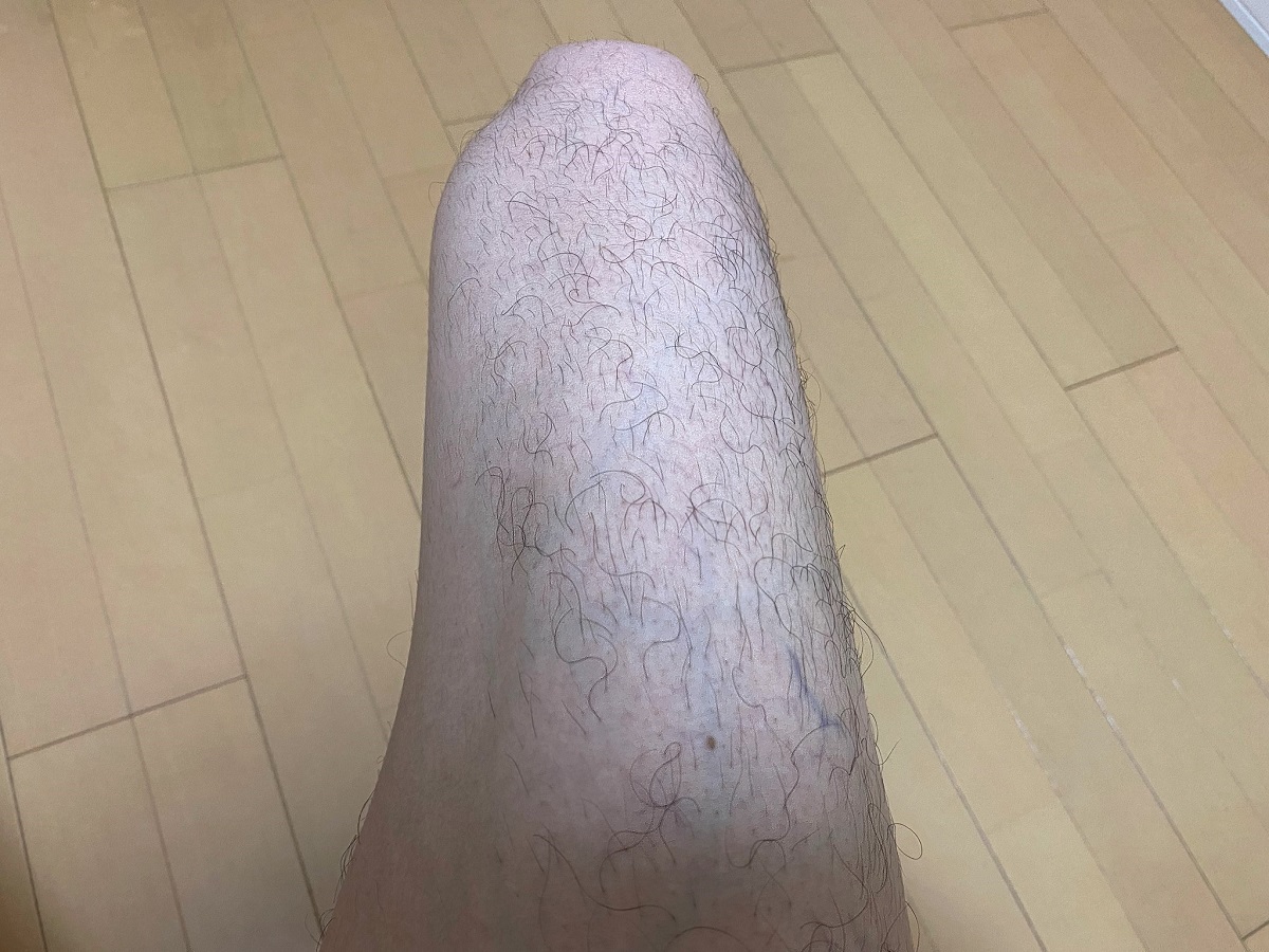 全身脱毛2回目の効果4カ月後