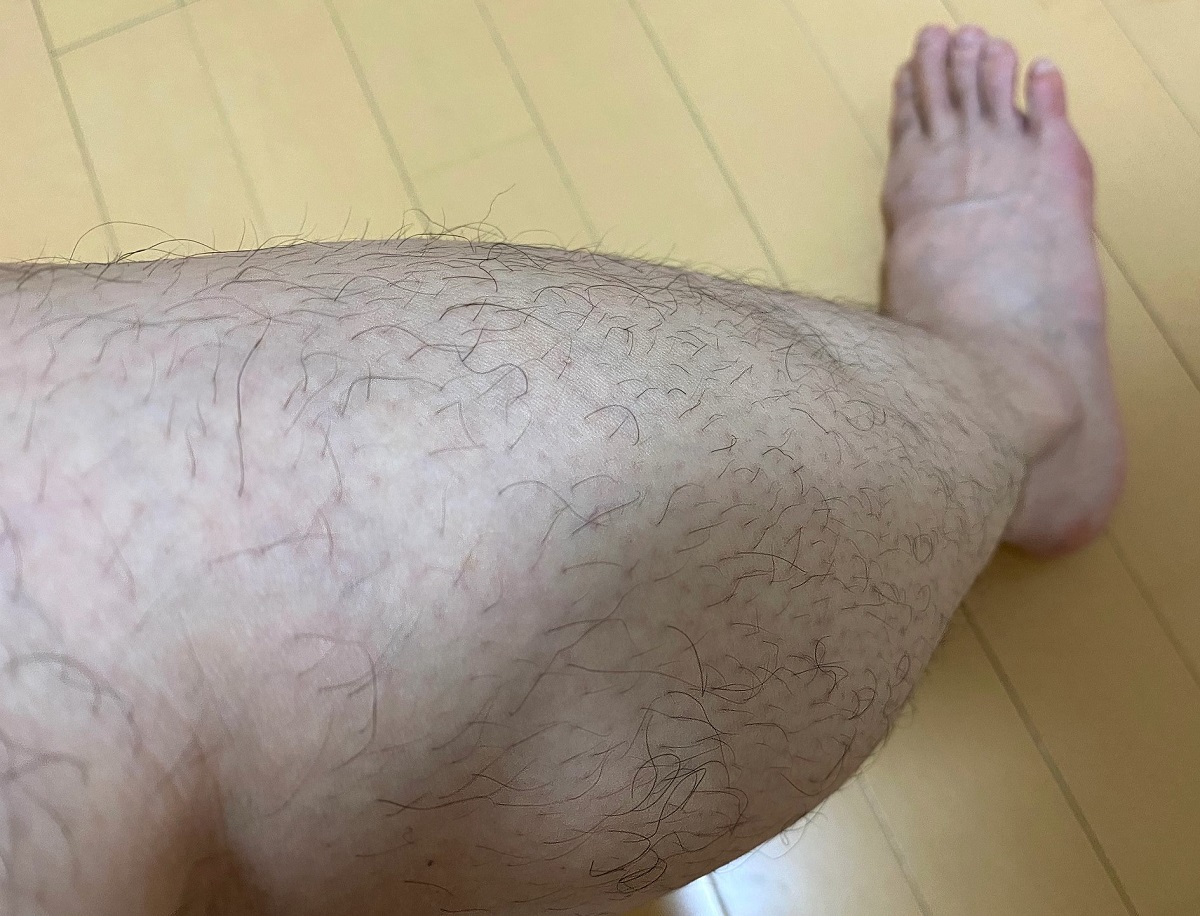 全身脱毛2回目の効果4カ月後