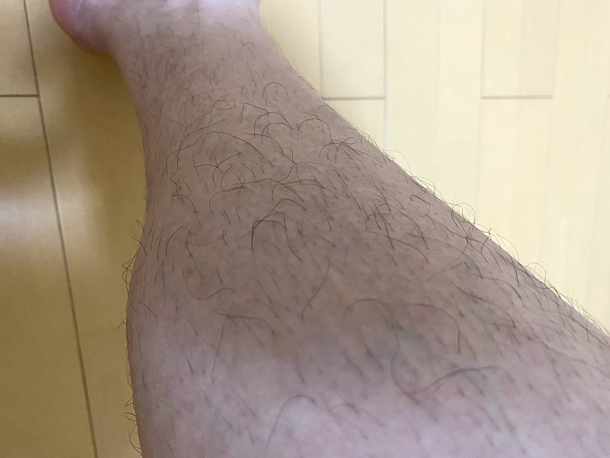 全身脱毛2回目の効果4カ月後