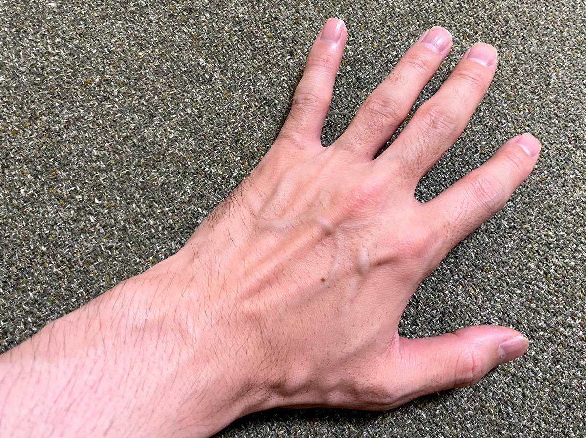 全身脱毛2回目の効果4カ月後