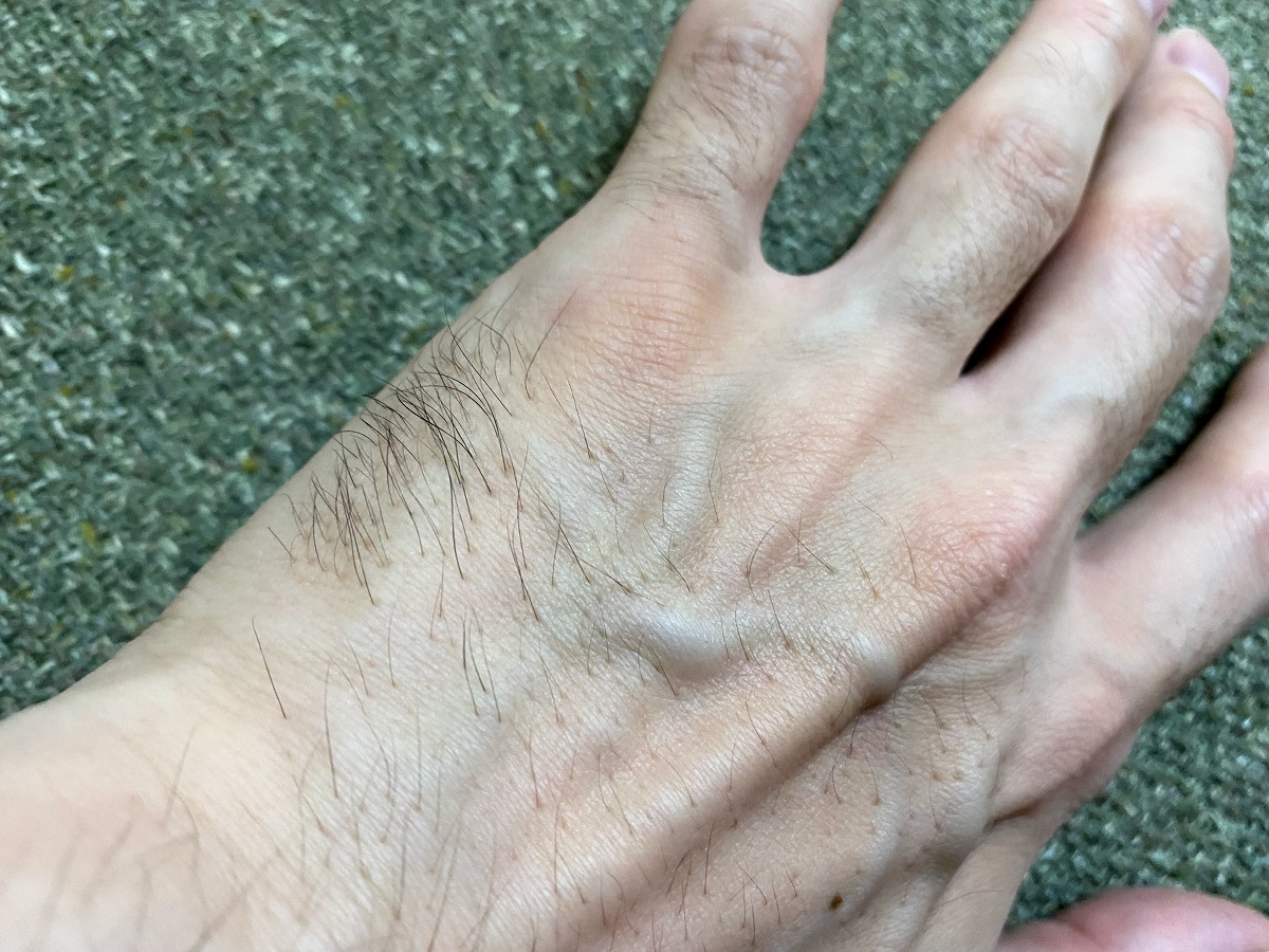 全身脱毛2回目の効果4カ月後
