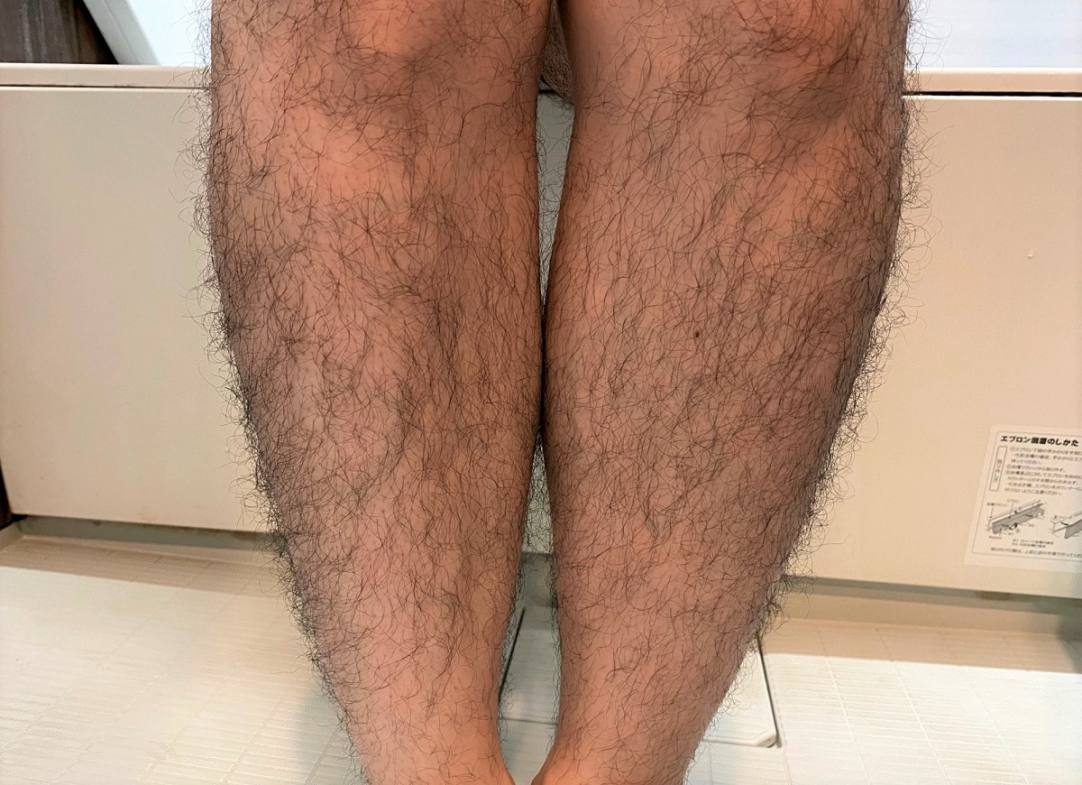 男の全身脱毛開始前
