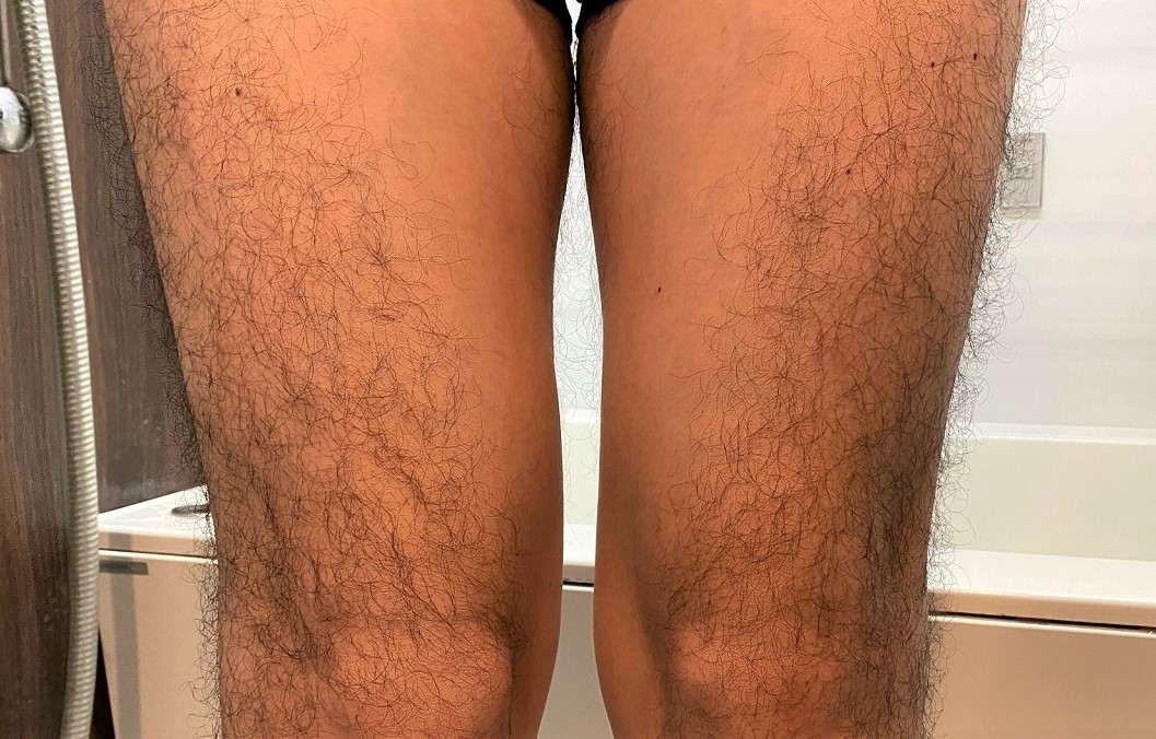 男の全身脱毛開始前