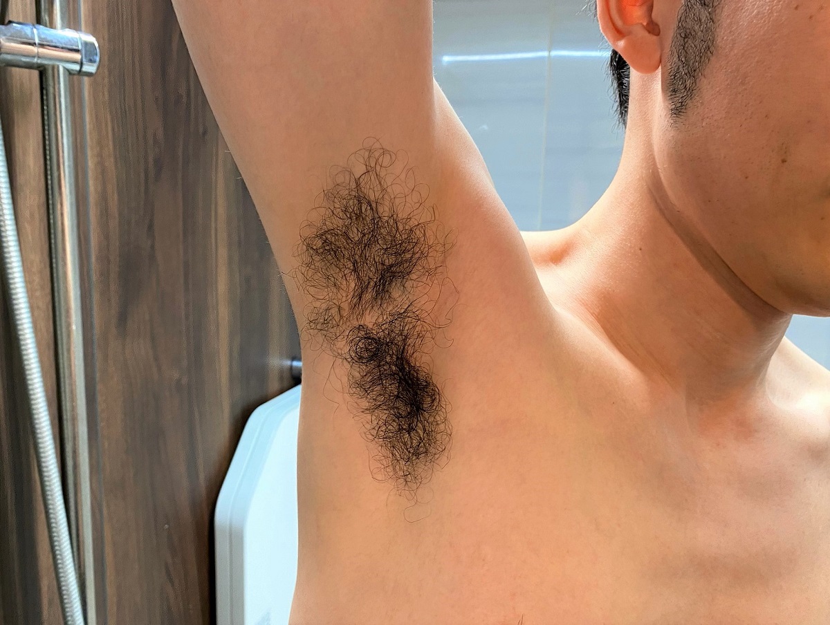 男の全身脱毛開始前