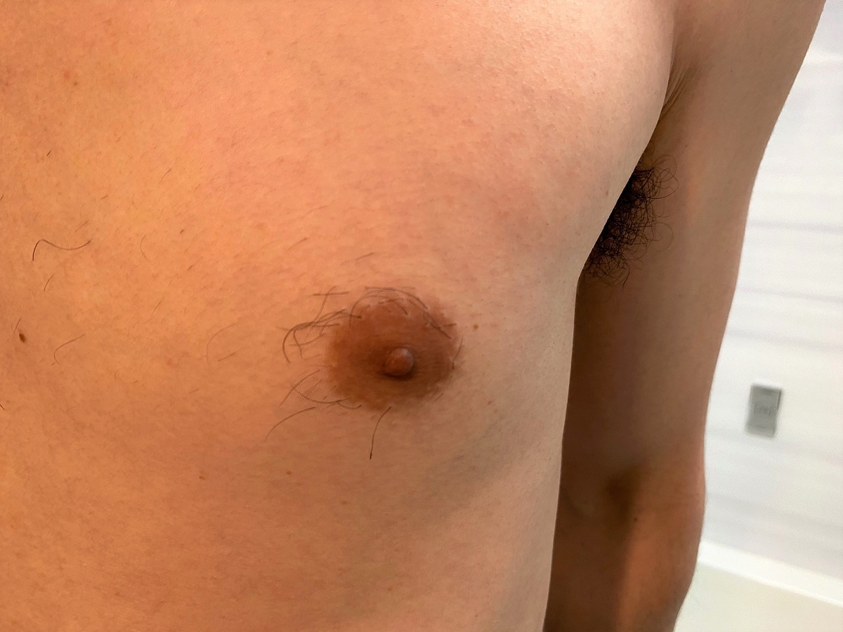 男の全身脱毛開始前