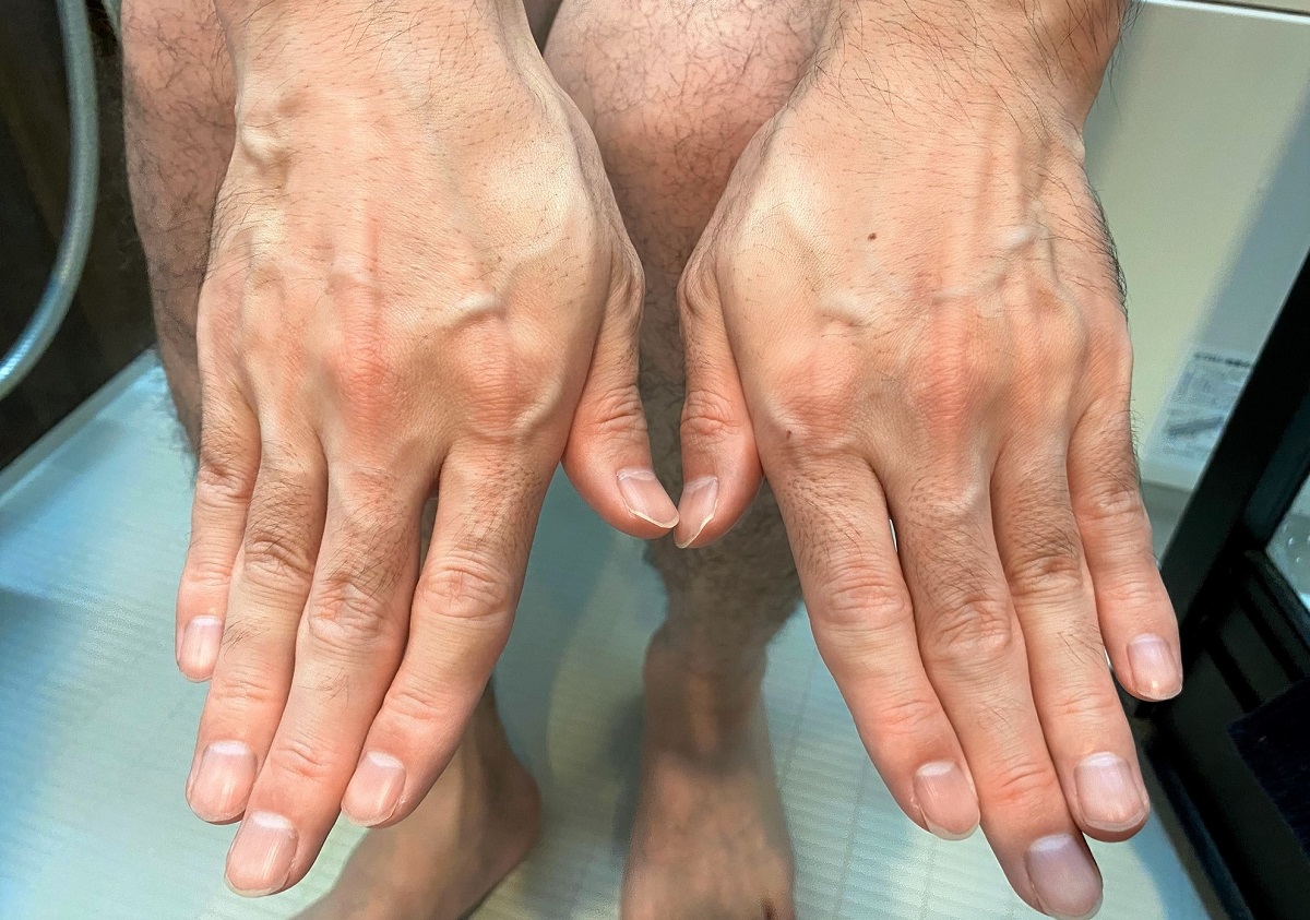 男の全身脱毛開始前