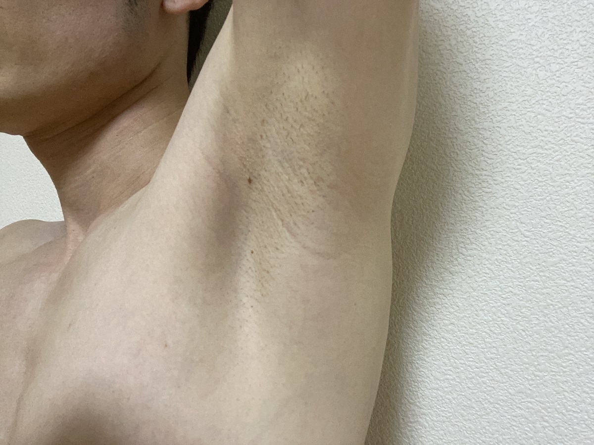 メンズわき脱毛の感想