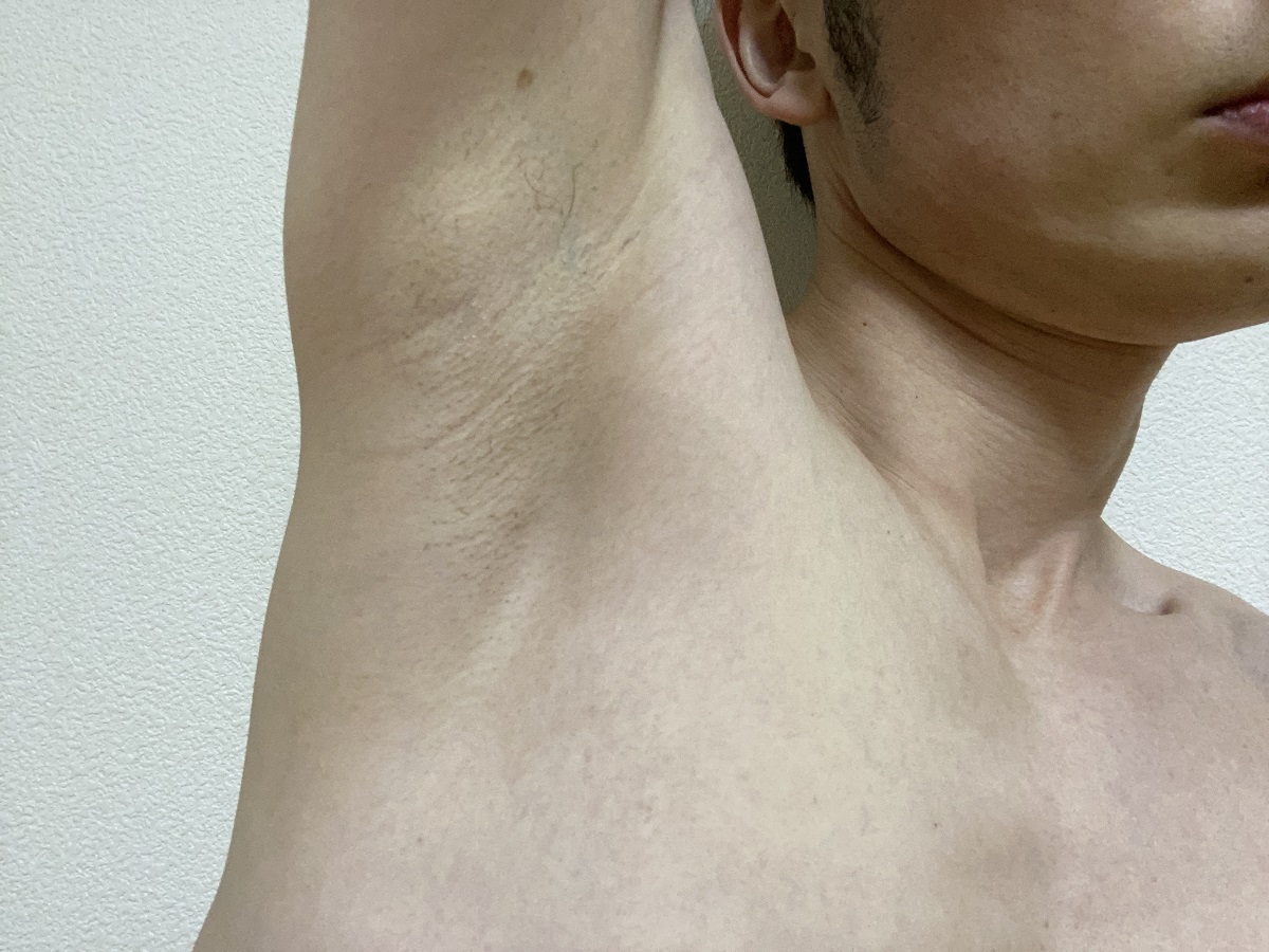 メンズわき脱毛の感想