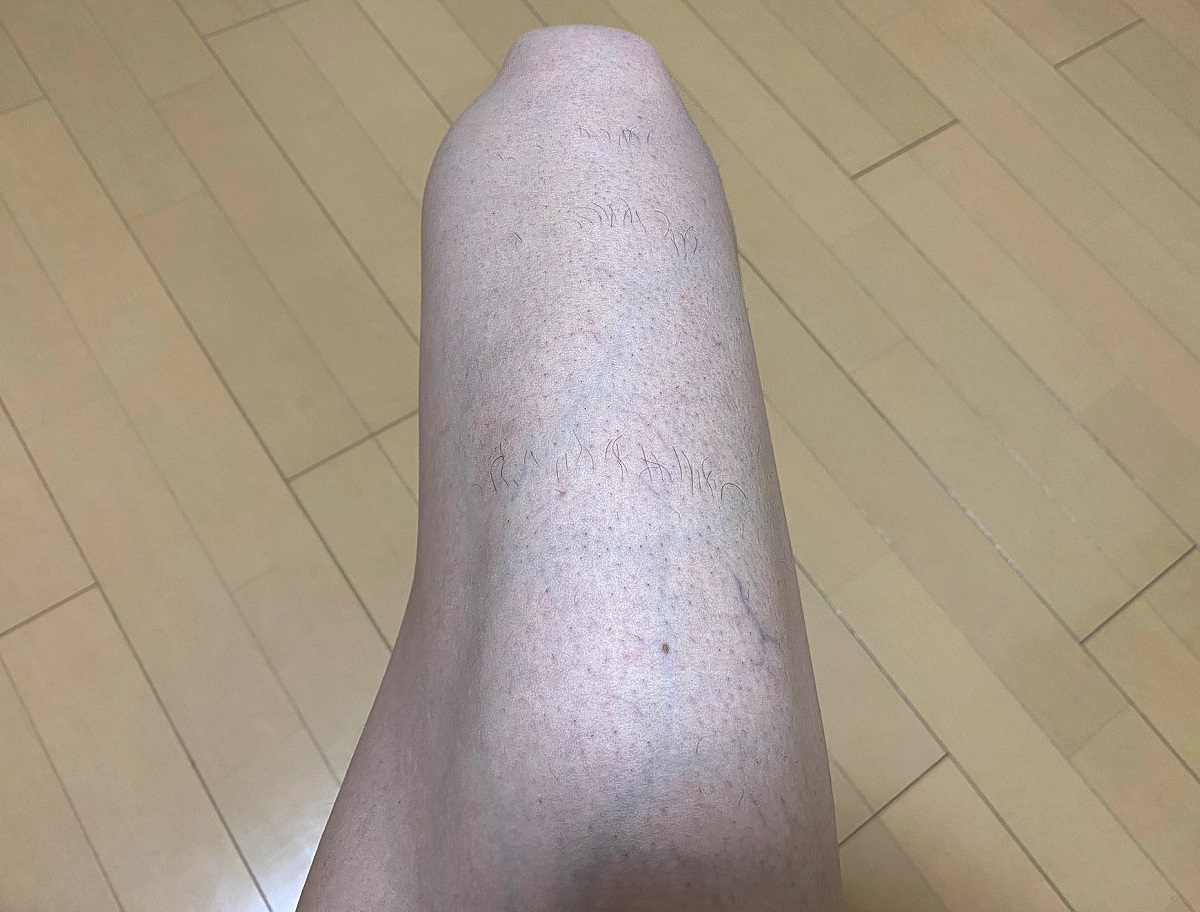男の全身脱毛前2回目の効果