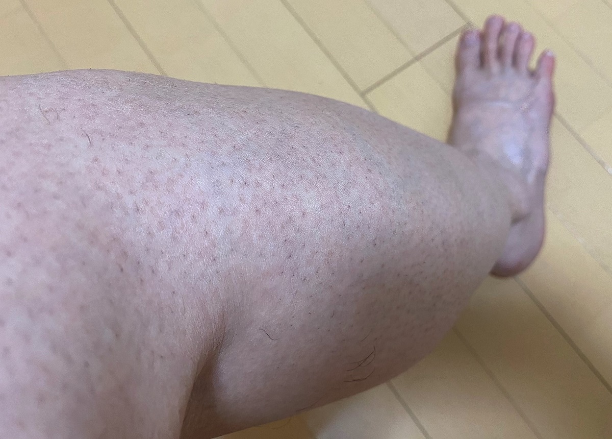 男の全身脱毛前2回目の効果