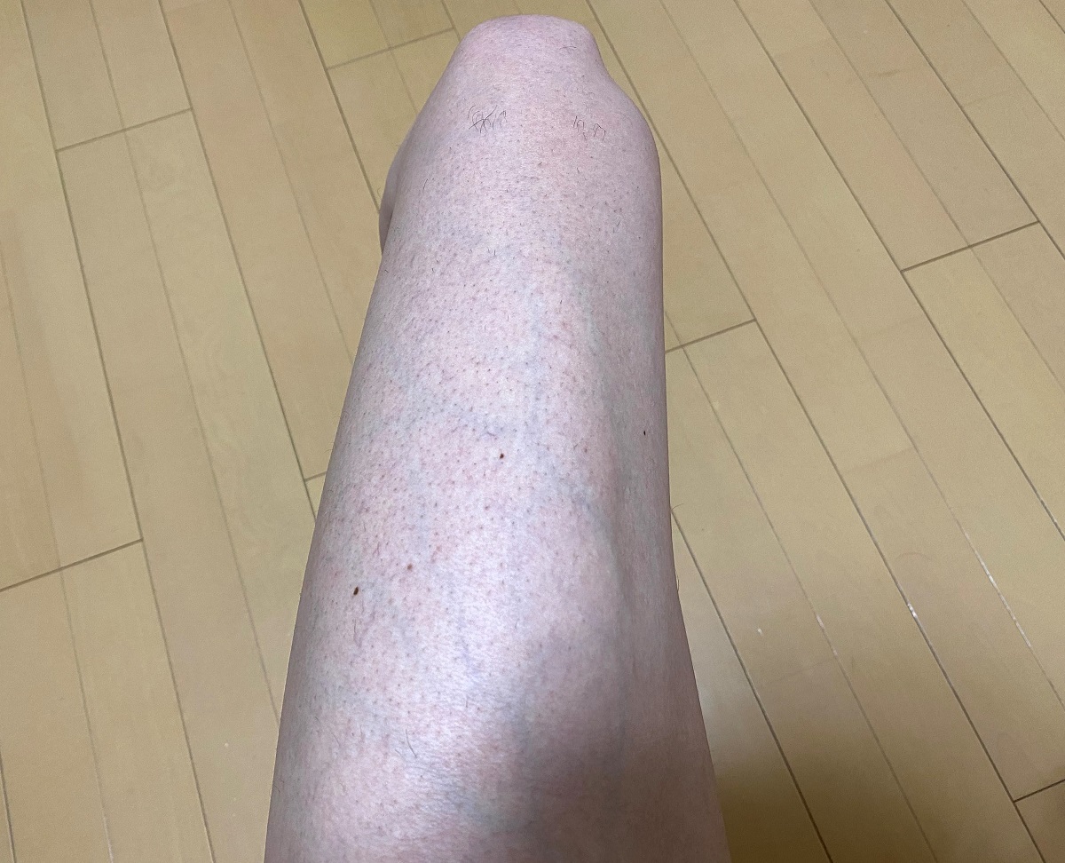 男の全身脱毛前2回目の効果