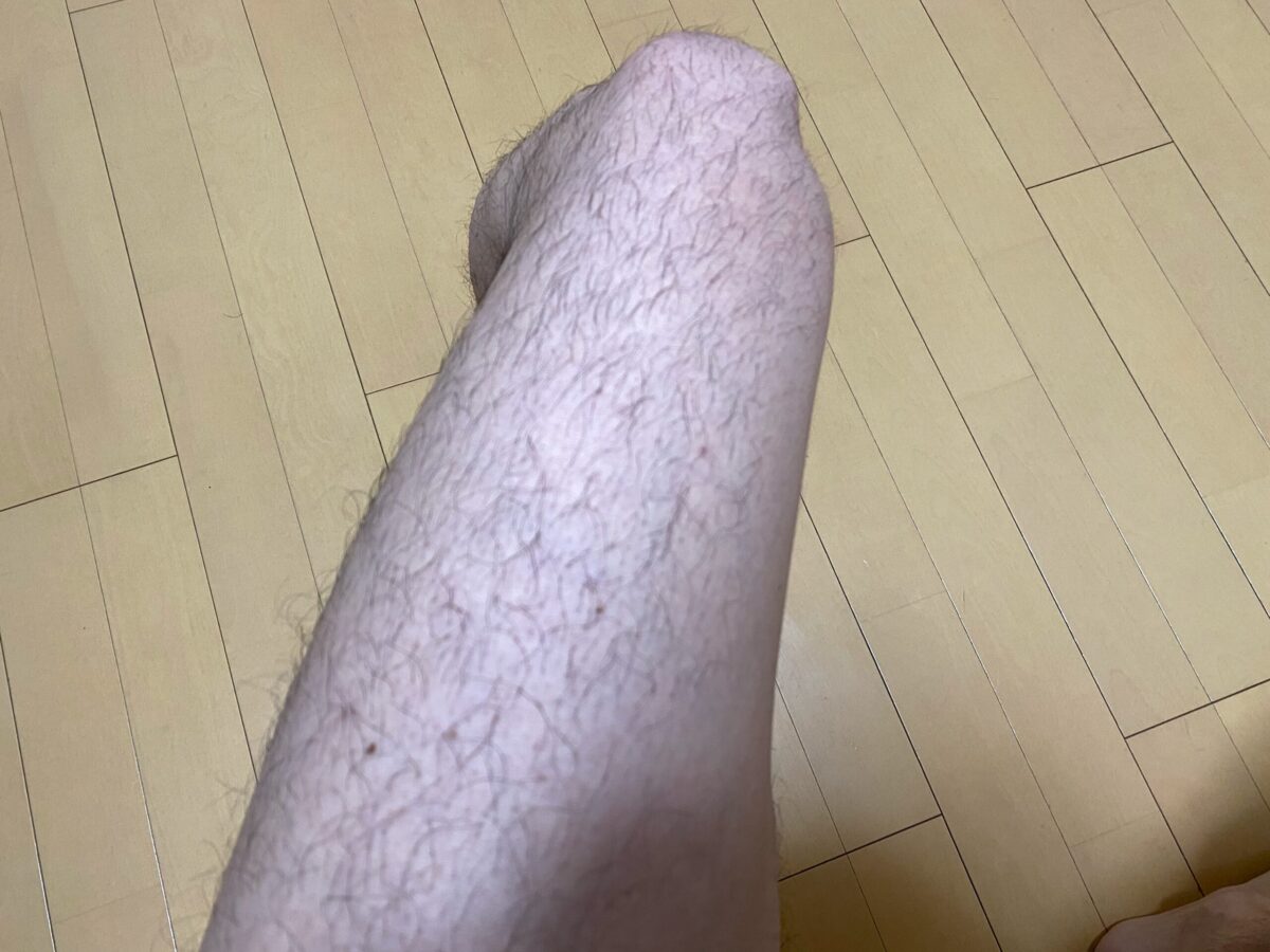 全身脱毛・脚脱毛4カ月後の効果