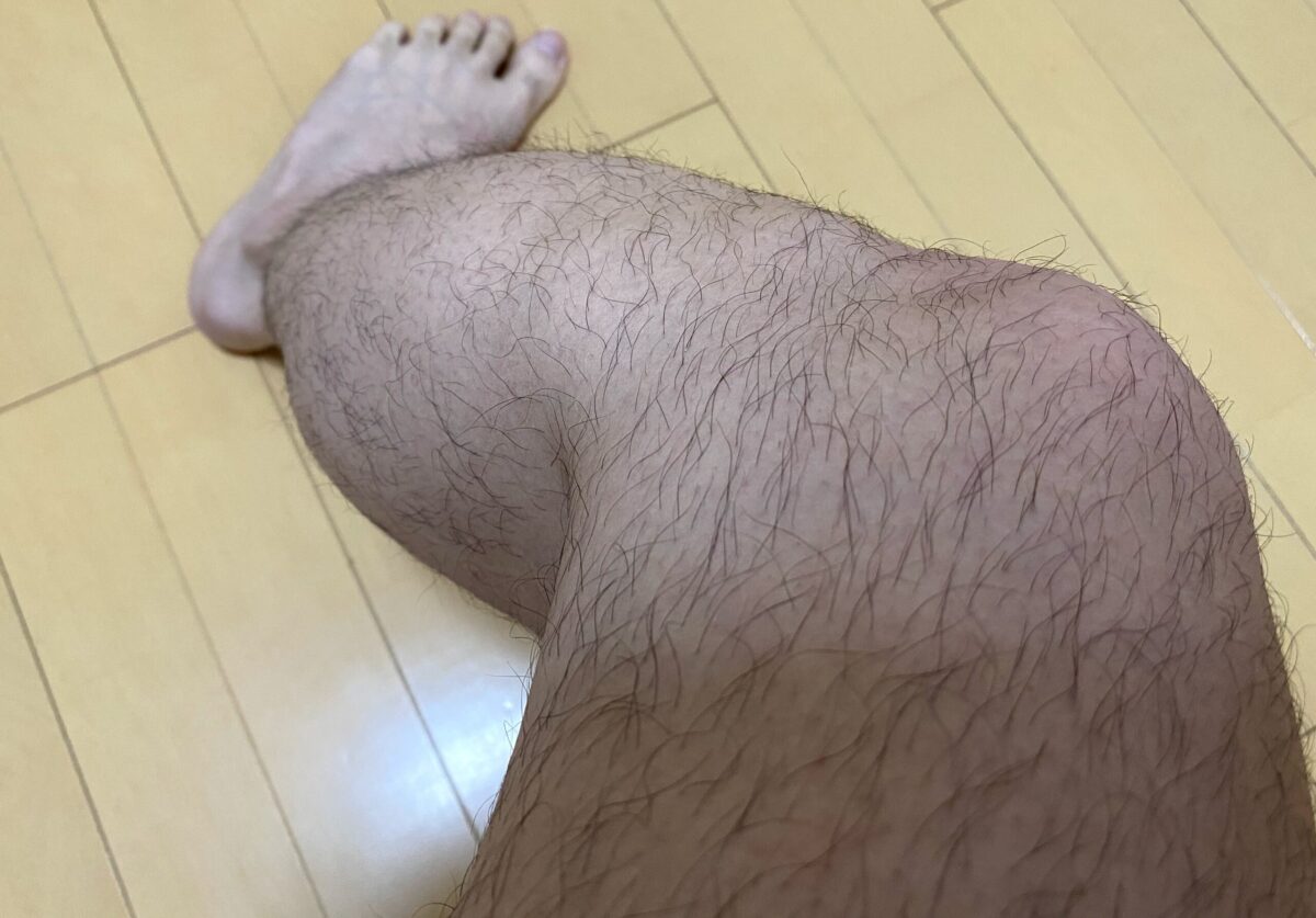 全身脱毛・脚脱毛4カ月後の効果