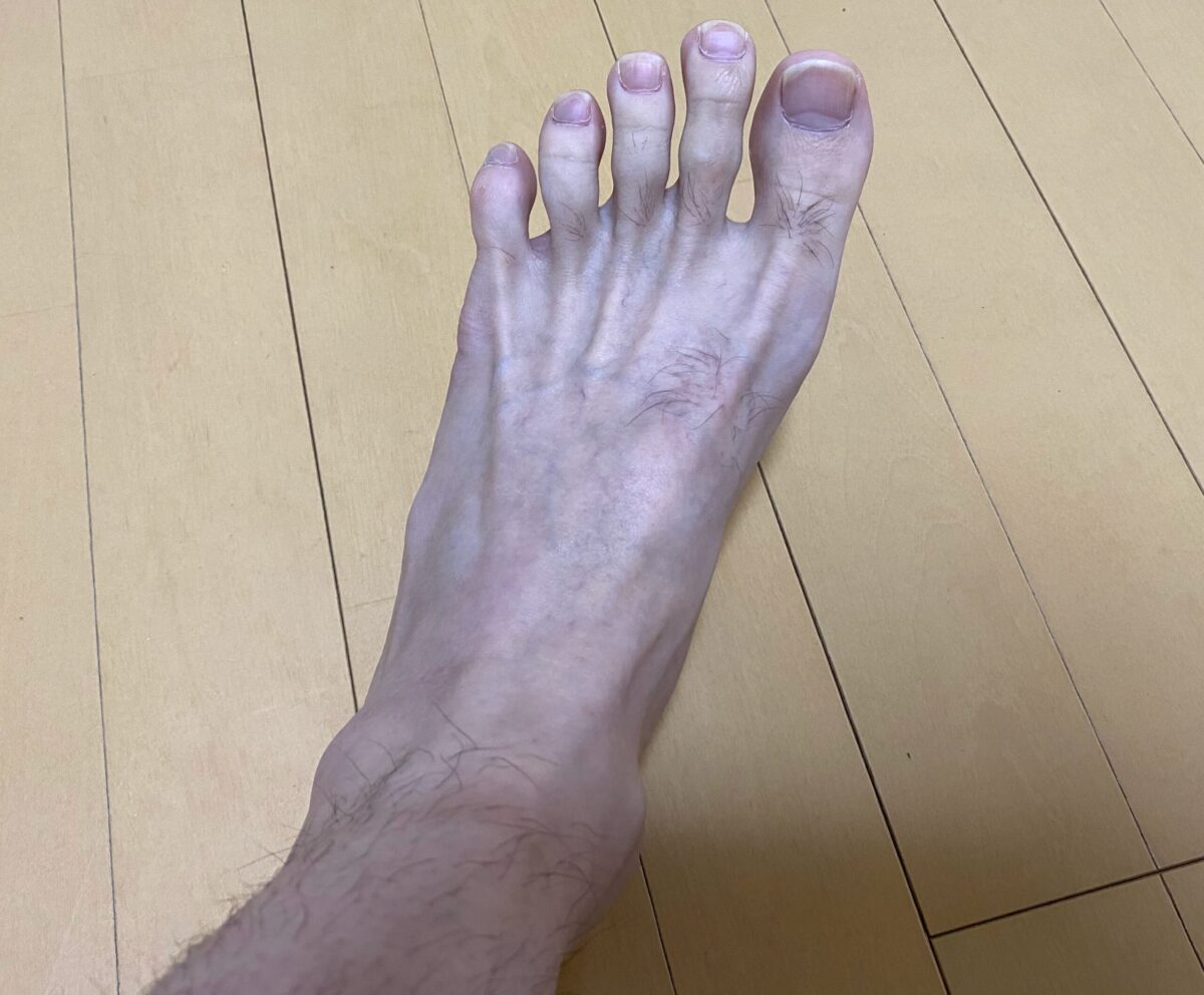全身脱毛・脚脱毛4カ月後の効果
