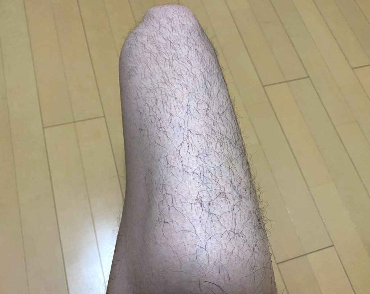 全身脱毛・脚脱毛4カ月後の効果