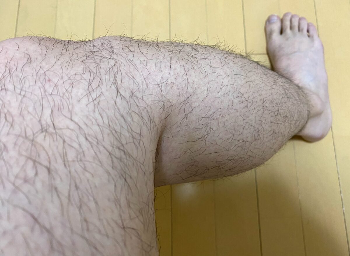 全身脱毛・脚脱毛4カ月後の効果