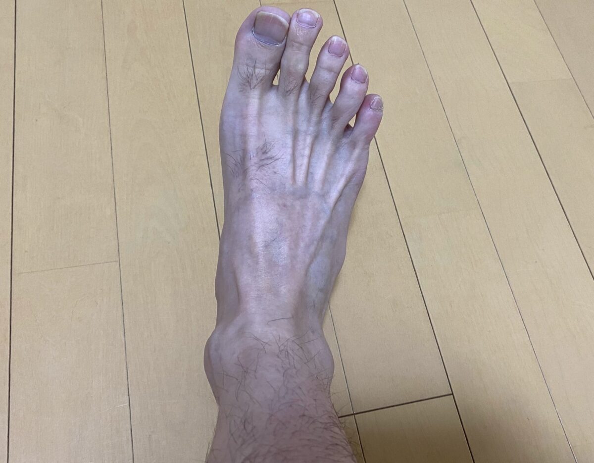 全身脱毛・脚脱毛4カ月後の効果