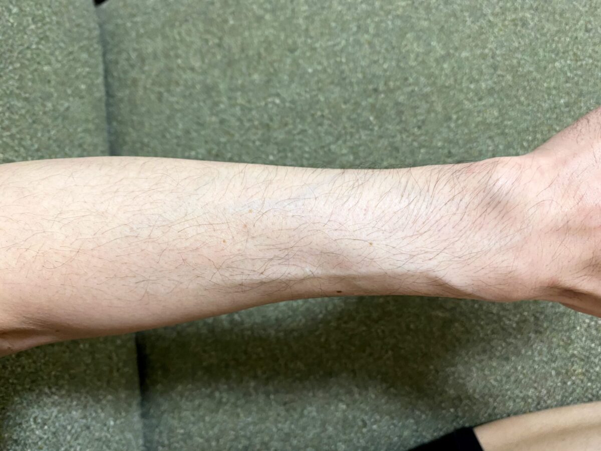 全身脱毛・腕脱毛4カ月後の効果