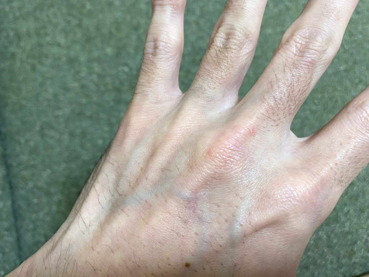 全身脱毛・腕脱毛4カ月後の効果