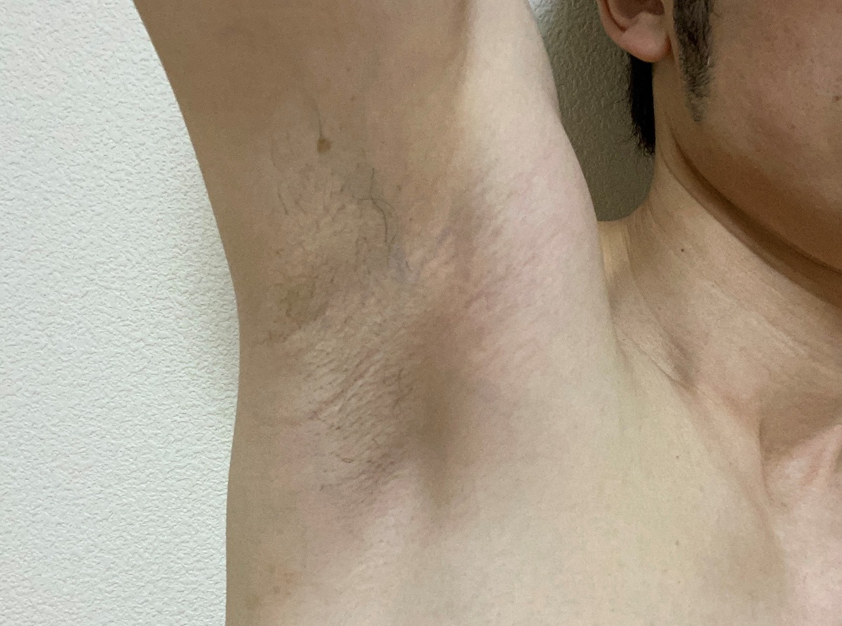 メンズわき脱毛の感想