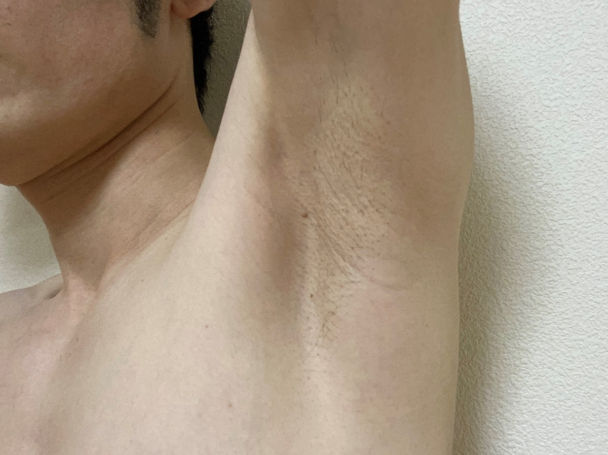 メンズわき脱毛の感想