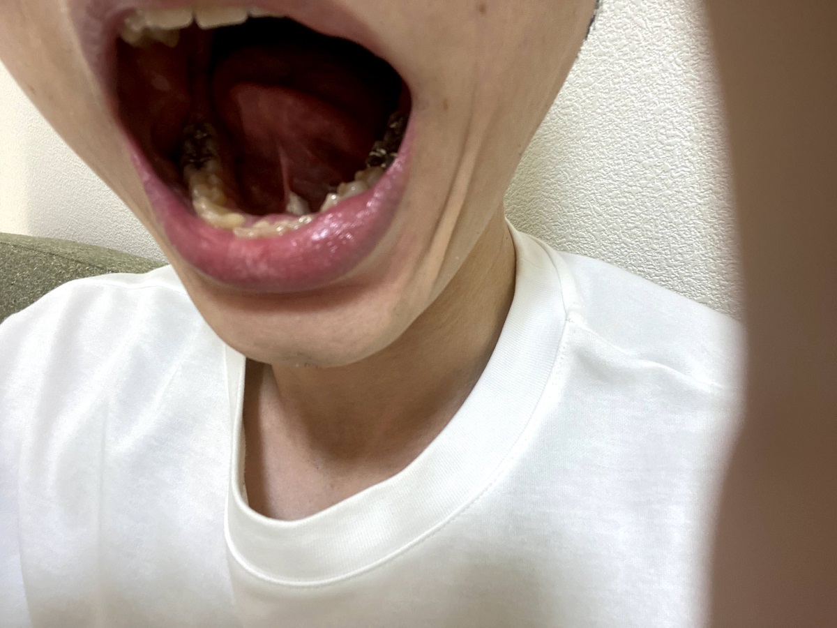 舌下免疫療法の薬の飲み方（体験談）