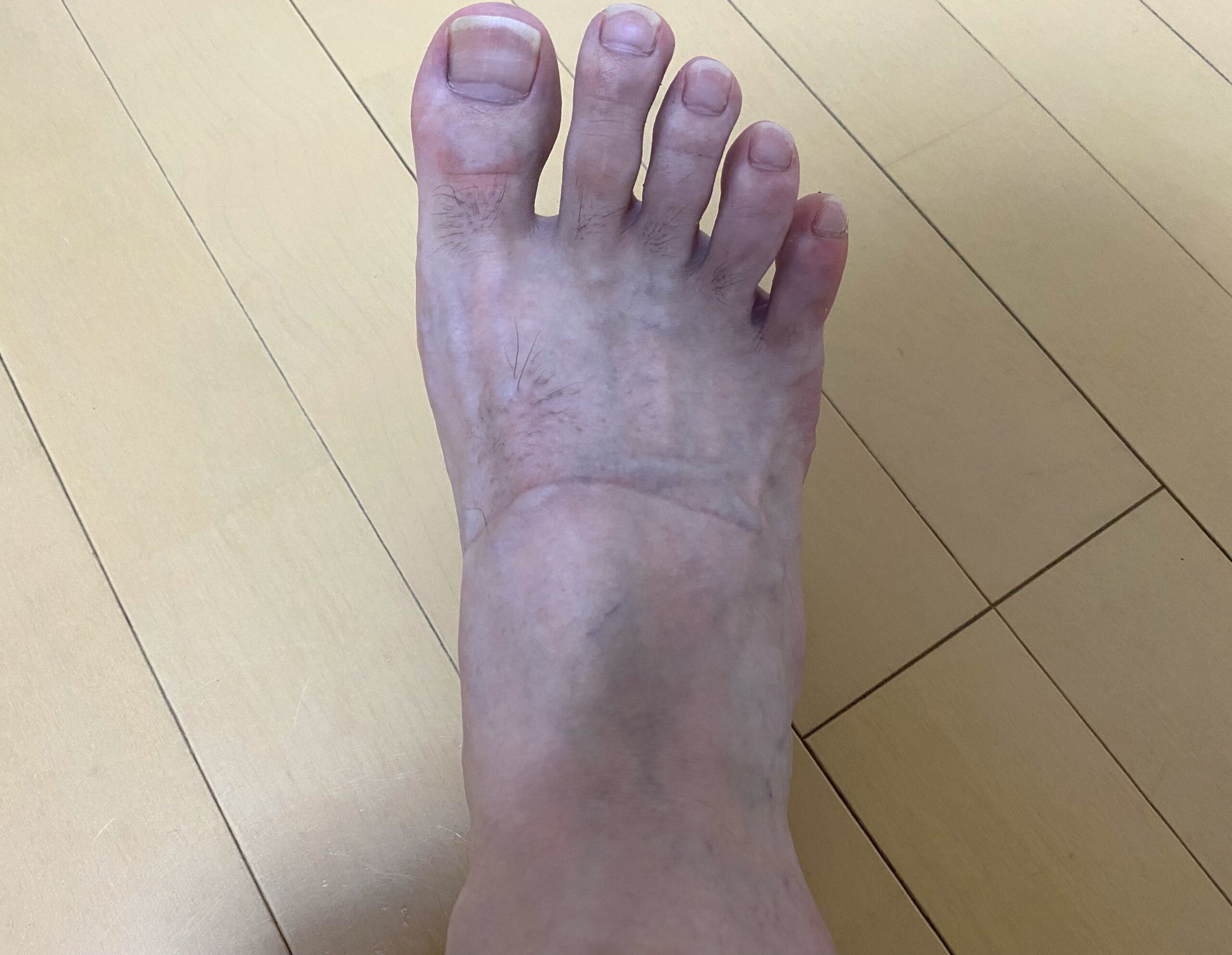 男の全身脱毛3カ月後の結果