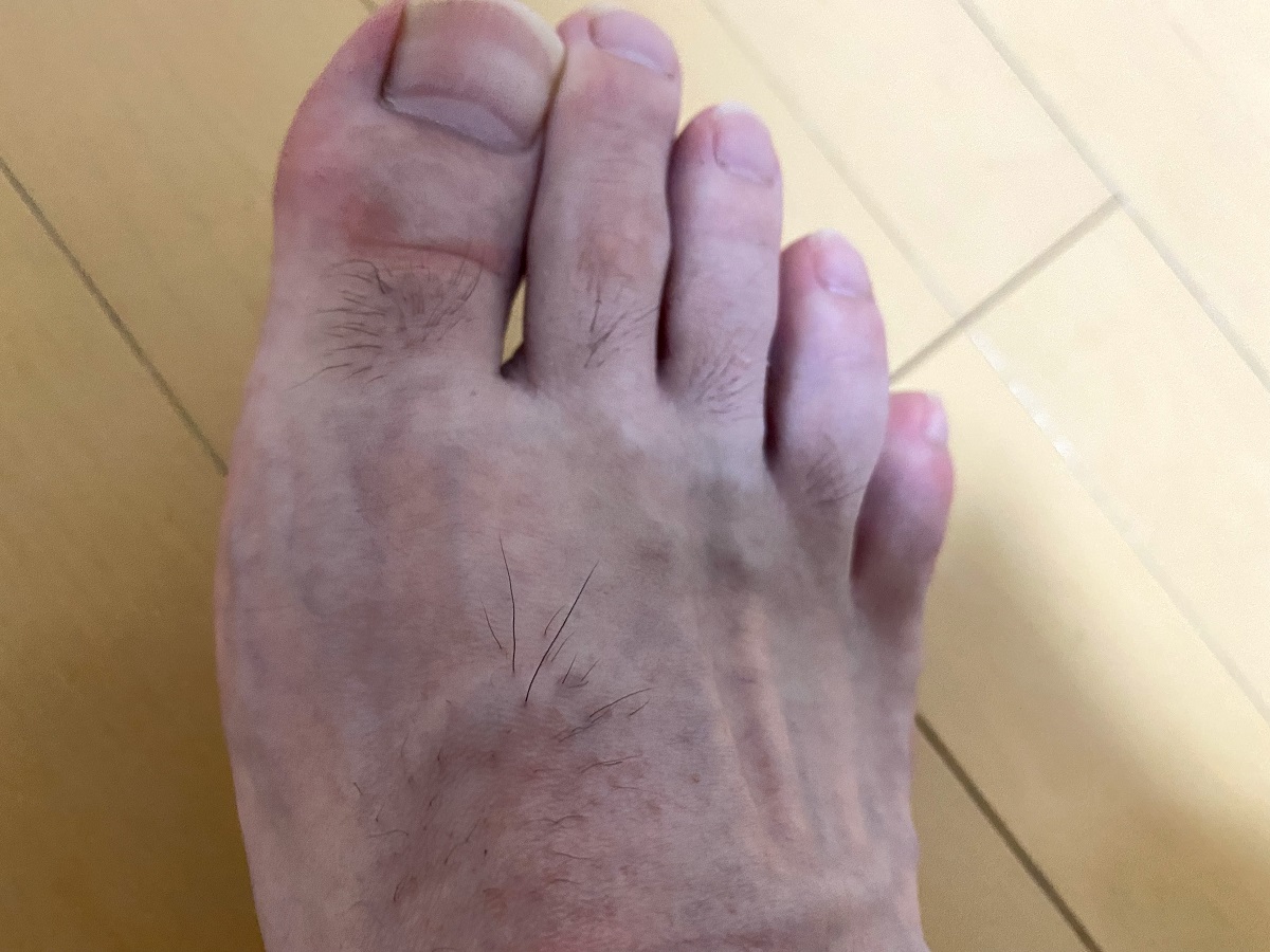 男の全身脱毛3カ月後の結果