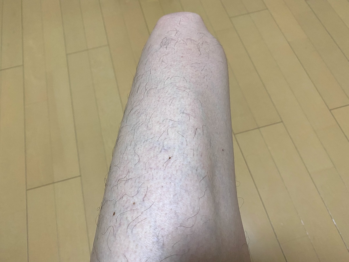 男の全身脱毛3カ月後の結果