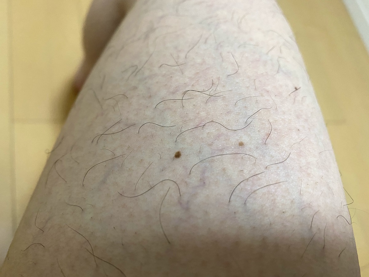 男の全身脱毛3カ月後の結果
