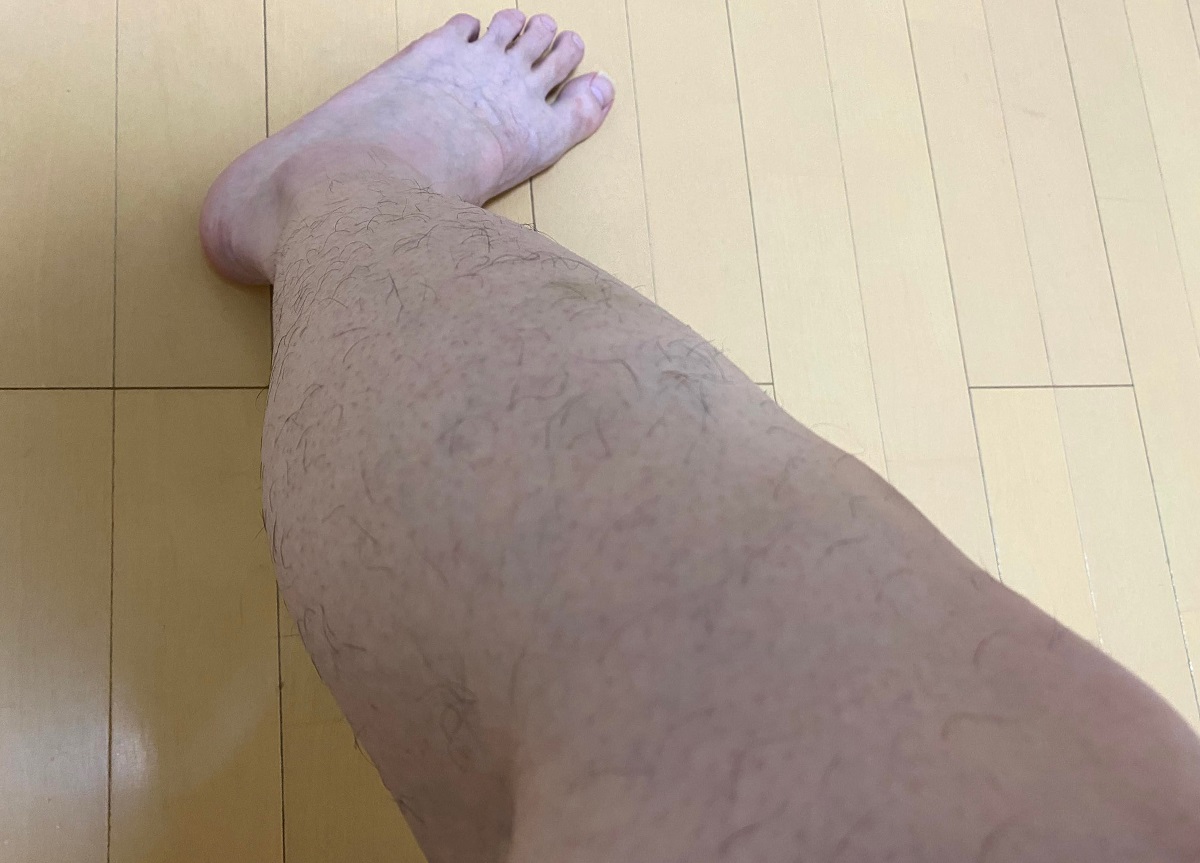 男の全身脱毛3カ月後の結果