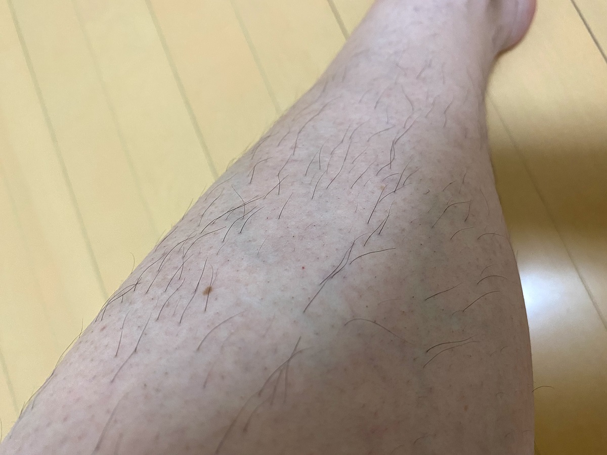 男の全身脱毛3カ月後の結果