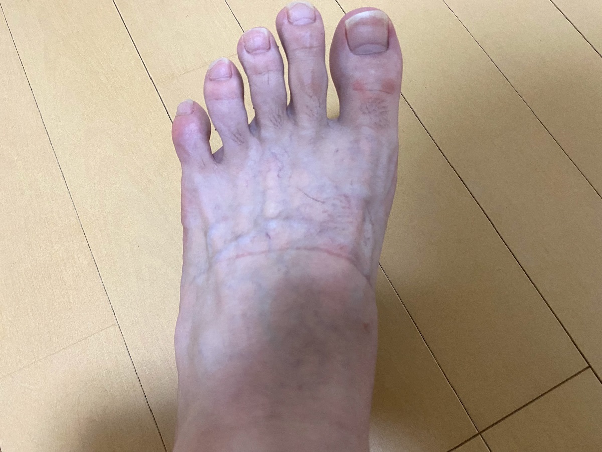 男の全身脱毛3カ月後の結果