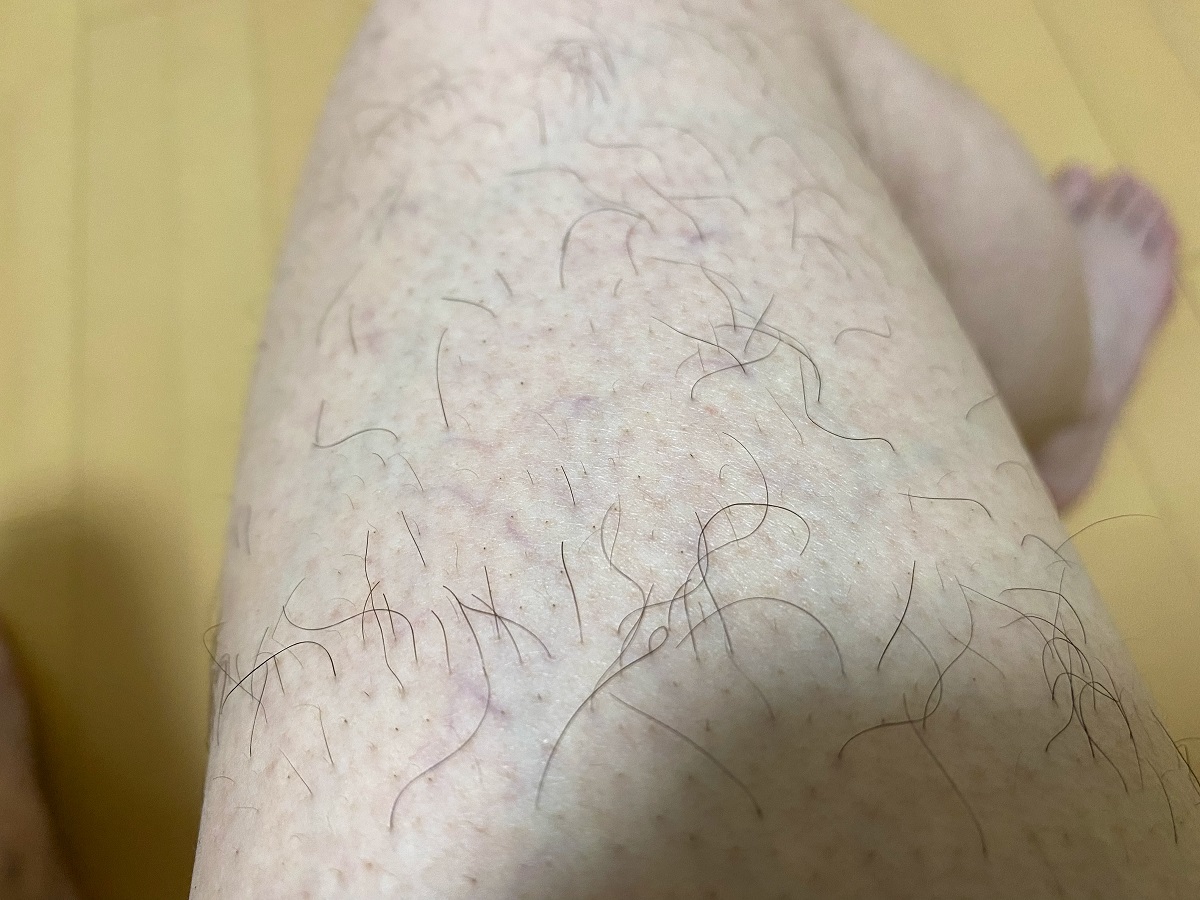 男の全身脱毛3カ月後の結果