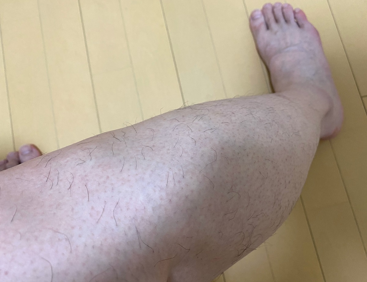 男の全身脱毛3カ月後の結果