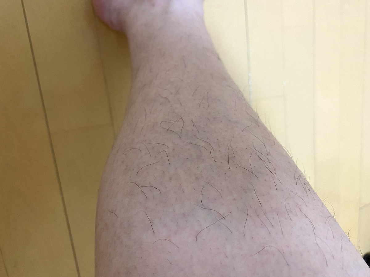 男の全身脱毛3カ月後の結果