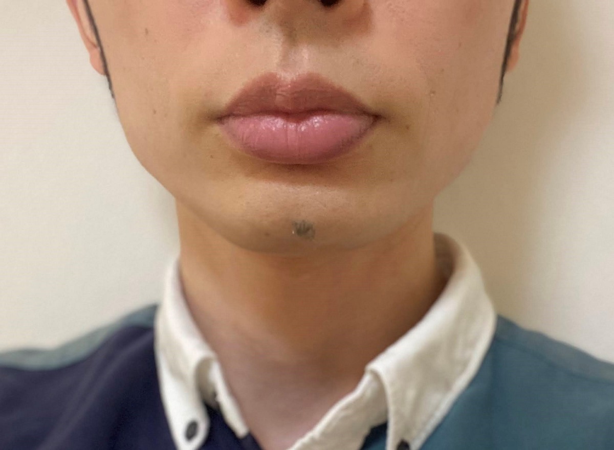 医療レーザーヒゲ脱毛21回目の効果