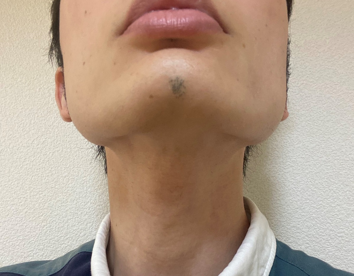 医療レーザーヒゲ脱毛21回目の効果