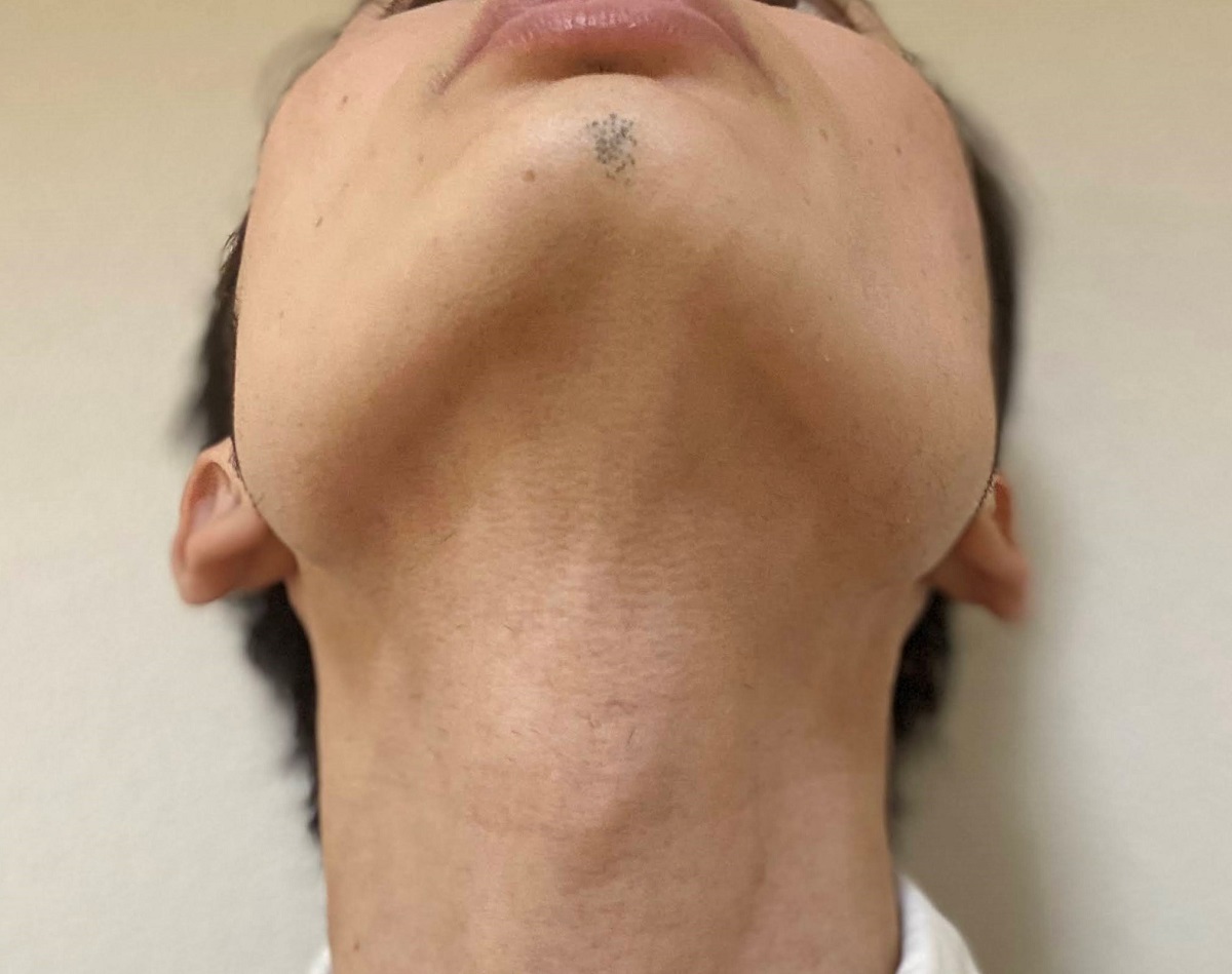 医療レーザーヒゲ脱毛21回目の効果