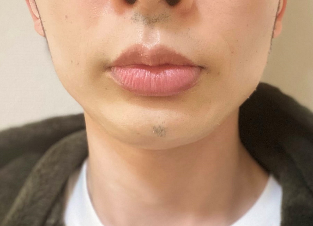 医療レーザーヒゲ脱毛21回目の効果
