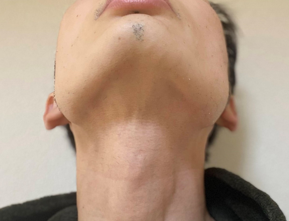 医療レーザーヒゲ脱毛21回目の効果