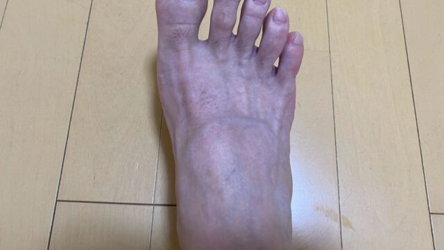 全身脱毛3回目の効果