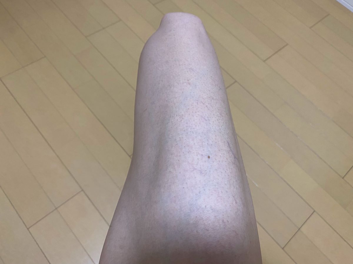 全身脱毛3回目の効果