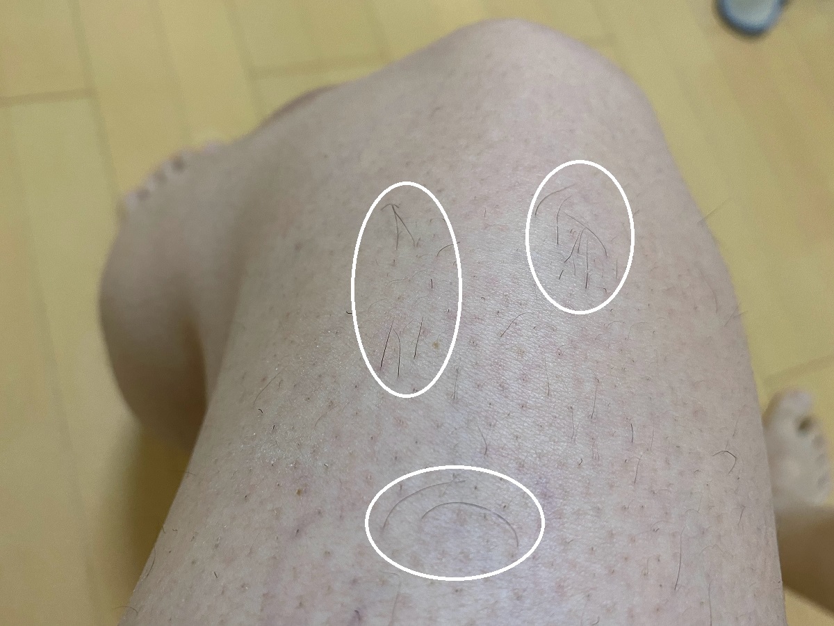 全身脱毛3回目の効果
