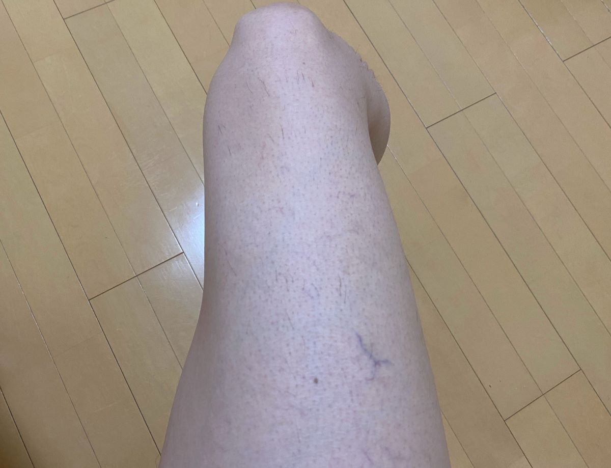 全身脱毛3回目の効果