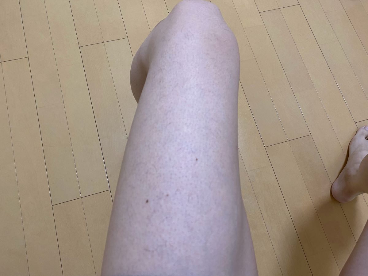 全身脱毛3回目の効果
