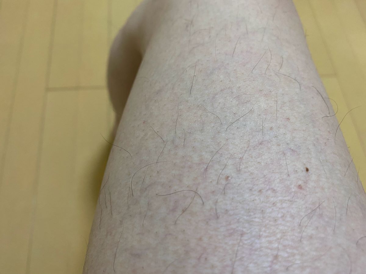 全身脱毛3回目の効果