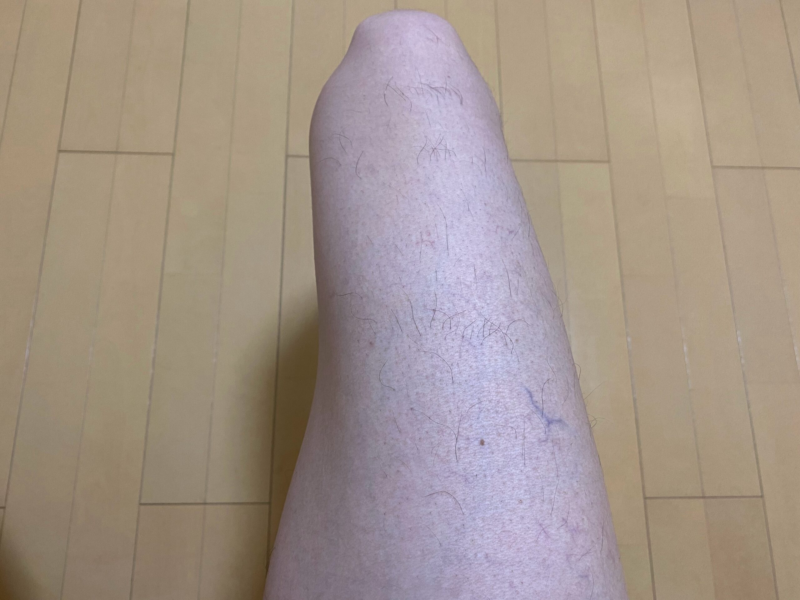 全身脱毛3回目の効果